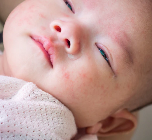 Mustela qu'est ce que la dermatite atopique? - Mustela France - 1