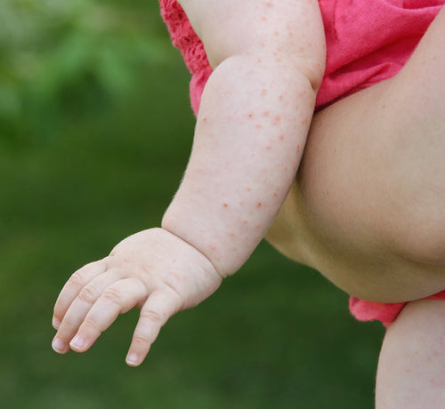 Mustela comment prévenir l'apparition de la dermatite atopique? - Mustela France - 1
