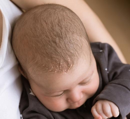 Les croûtes de lait du bébé : causes et symptômes