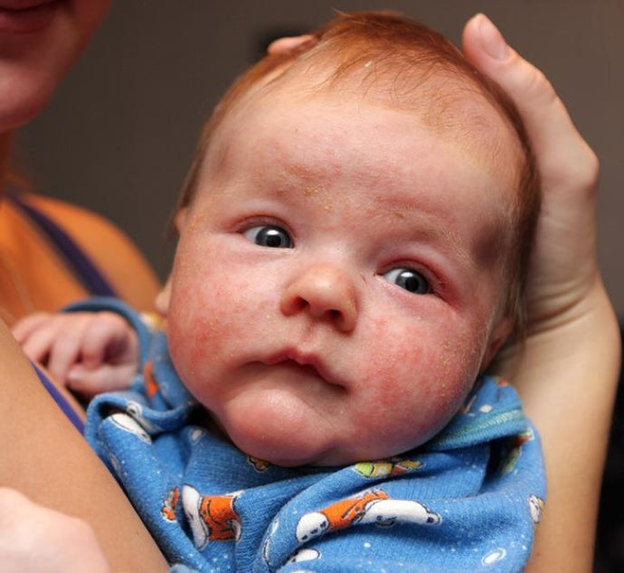 Comment reconnaître un eczéma atopique chez un bébé ?
