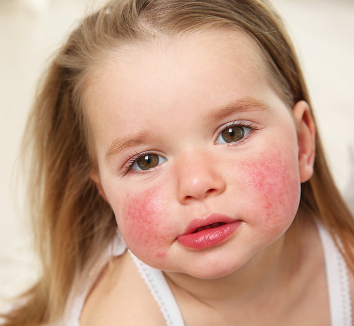 La dermatite atopique du bébé et de l’enfant : notre FAQ
