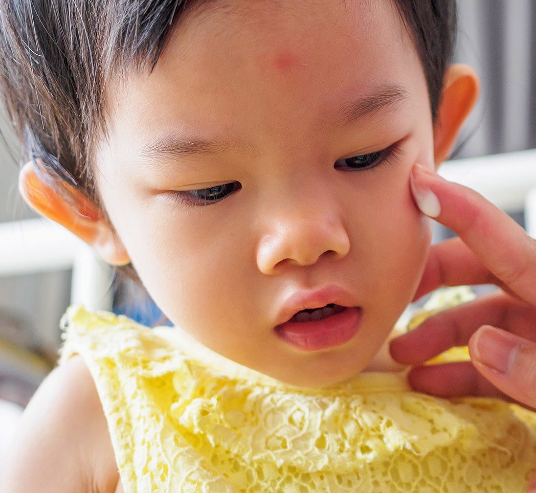 Traiter l'eczema : Comment soulager les démangeaisons enfant ?
